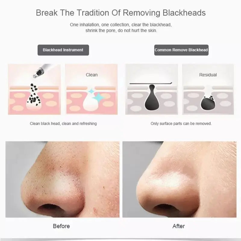 Blackhead Remover Vacuum Pore Cleaner Electric Beauty Skin Care